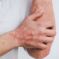 BÔi DA CHÀM VẨY NẾN Đánh Bay Vẩy Nến Viêm Da Cơ Địa Ngứa Da Tay Chân Khuỷu Tay Da Đầu Luôn Có Sẵn 