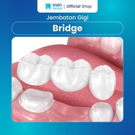 Sozo Dental - Bridge Gigi Crown Permanen