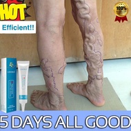 Varicose Veins Cream Effective Vasculitis Phlebitis Remover Spider Veins Pain Varicosity Angiitis Oi