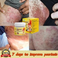 Eczema Cream Antifungal Cream Cream Eczema Psoriasis Cream 20g Quickly Relieves Itching Removes Ecze