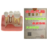 AZDENT? Dental Model Implant Analysis Crown Bridge Demons