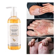 Eczema treatment eczema bath lotion eczema lotion antifungal tinea psoriasis treatment antipruritic