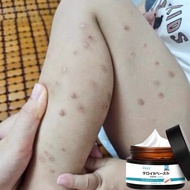 Ubat parut Hilangkan parut hitam Hilangkan parut kaki Menghilangkan bekas luka lama Scar Burns Parut