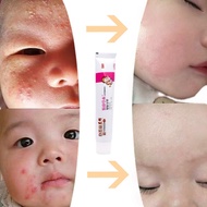 Eczema Cream baby krim gatal Removal prickly heat Eczema Treatment mosquito bites  Ringworm Psoriasi