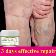 Varicose Vein Cream Varicose Veins Treatment Anti Varicose Veins Ointment 50g Effective treatment of