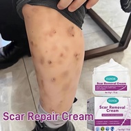 Scar Repair Cream 50g Acne and Scar Removal Cream Stretch Mark Cream Acne Treatment Remove Scar Crea