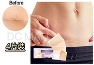 大熱産品 - 《4片裝》EELHOE 美容疤痕修復貼 矽膠手術傷疤貼 剖腹疤痕貼 燙傷疤痕貼 燒傷美容貼 傷口修護疤痕貼 妊娠紋貼 燙傷除疤貼 褪疤貼 疤痕護理貼 矽膠傷疤貼 淡化疤痕貼 疤痕剋星