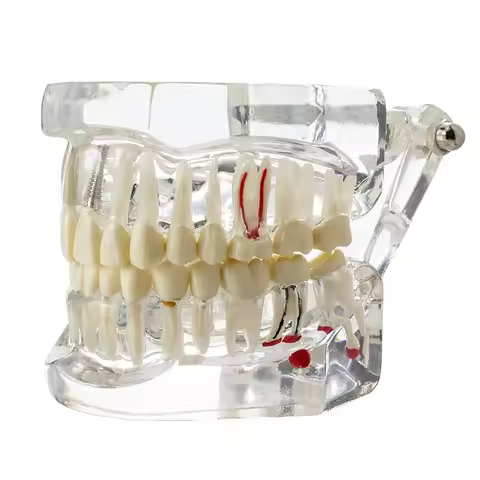 Dental Disease Implant Teeth Model 3 Unit Bridge Restoration Teach Study Training Demo for Dental Co