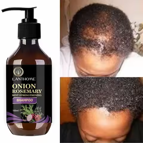 Hair Shampoo For Fast Hair Growth Rosemary Onion Shampoo Spray Anti Hair Loss Effective Within 7 Day