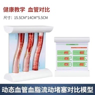 Cardiovascular and Cerebrovascular Blockage Model Joint Thrombosis Blood Concentration Fat Pathology