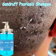 psoriasis shampoo ubat kulit kepala pristine shampoo hair dandruff kelemumur dan gatal kepala Psoria