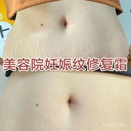 Stretch Marks Prevent Stretch Marks Repair Cream Stretch Marks Remove Obesity Marks Postpartum Pregn