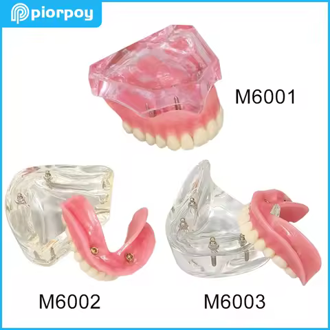 PIORPOY Dental Teaching Model Removable Overdenture NISSIN Kilgore Style Implants Teeth Models for D
