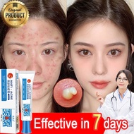Acne Cream Acne Cream Effective Acne medicine Pimple cream Fast removal Cream Acne removal Cream Acn