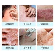 Skin Itching Discomfortable Mosquito Bites Bites Anti-Bite Cream Skin Acne Hand Foot Peeling Whole B