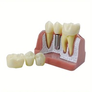 Teeth Model Dental Implant Model Dental Teaching Model Removable Tooth Model