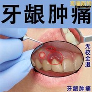 【公司貨】牙齦膿痛腫發炎出血腫痛腫包牙齦萎縮牙齦瘻管牙齦瘤結石牙痛智齒