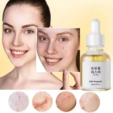 Propolis And Salicylic Acid Acne Treatment Essence, Pore Refining Essence, Glutathione And Niacinami