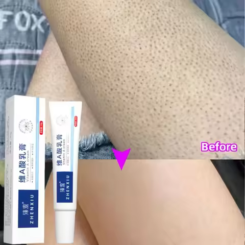 Body Whitening Cream Keratosis Pilaris Treatment Bumpy Rough Chicken Follicle Skin Repair Strawberry