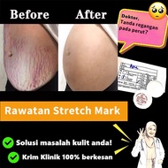 krim stretch mark produk penjagaan kulit wanita hamil untuk menghilangkan stretch mark