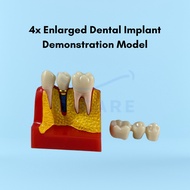 4x Enlarged Dental Implant Demonstration Model Implant Training Tool Dental Clinic Teaching Aid Mode