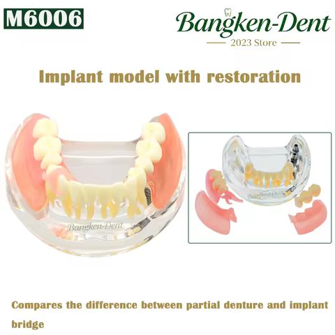 Dental Implant Teeth Model Typodont Overdenture 3 Implants M6006 Inferior Lower Bridge Restoration T