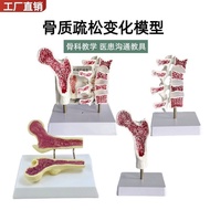 Sectional model of diseased femur and leg, loose model for anatomy, lumbar spine bone structure, hum