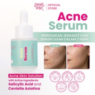 OH MY SKIN ACNE SERUM Skin Solution Facial serum for treating ACNE and blackheads