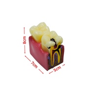1pcs Dental Teeth model 6 Times Caries Study Denture Tooth Models Dentist Studying Researching 6 Tim