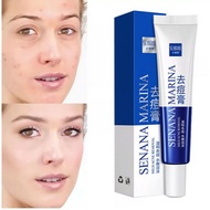 Senana MARINA Acne Remover Cream, Improves Skin Texture Of Acne Stains