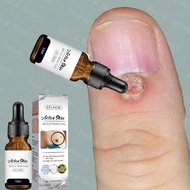 100% effective Warts Removal Serum warts and skin tags remover Warts Remover Original Cream Original
