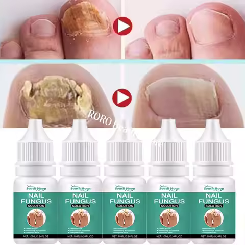 Fungal Nail Treatment Essence Oil Nail Fungus Laser Device Repair Toenail Fingernail Ginger Treatmen