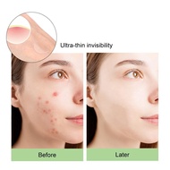 [cod] Hydrogel Acne Patch Skin Care Sticker Invisible Acne Patch Hydrocolloid Facial P1e9