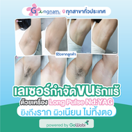 [E-voucher] Gangnam Clinic - เลเซอร์กำจัดขนด้วย Long Pulse Nd:YAG บริเวณรักแร้ (1 ครั้ง)
