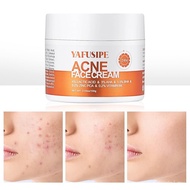 AcneTreatmentforFaceforHormonalCysticStubbornAcneforSensitiveSkinTeensAdultsWomenMenSpotPimpleButtCo