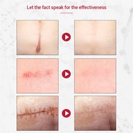 ♞,♘,♙Dermatix Scar Remover Contractubex Scar Gel Original Magic Scar Remover Gel Original Silicon G