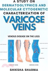 A Study on Dermatoglyphics and Molecular Cytogenetic Characterization of Varicose Veins