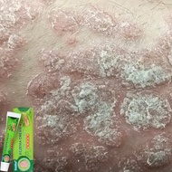 Eczema Cream Ubat Gatal Krim Psoriasis Cream krim gatal Eczema Treatment Antifungal Cream  Ubat peny