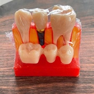 Implant consultation jaw model