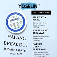 Krim Jerawat Yoselin® Acne Cream Acne Spot Treatment Oily Acne Prone Skin Cream in 7 day kecut acne