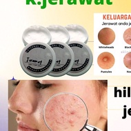 krim jerawat,jerawat muka,jerawat pipi,jerawat belakang,jerawat badan,jerawat banyak,jerawat punggun