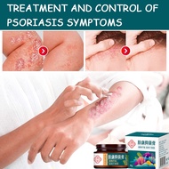 Ubat gatal kulit Ubat gatal kemaluan Econazine cream antifungal Ubat kurap Krim gatal celah kangkang