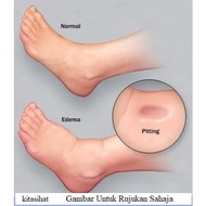 Masalah KAKI sembab EDEMA Kaki Bengkak Air #PIL bty#LAINindividuLAINkesan ⭐Ubat Tradisional