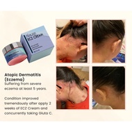 Natural cream made from plants for Eczema / Psoriasis / Antifungal / Non Steroid Cream - Alazne ECZ 