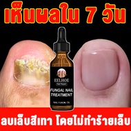 🔥7วัน ซ่อมแซมเล็บเสียอย่างรวดเร็ว🔥เล็บเชื้อรา 30ml แก้เชื้อราที่เล็บ บำรุงเล็บ ลากับเล็บเสีย ไม่ทำร้