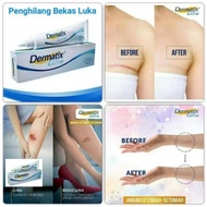 Original Dermatix ultra Scar Gel 15g，Dermatic Acne Scar Reduction Cream Advance Gel Scar Formula