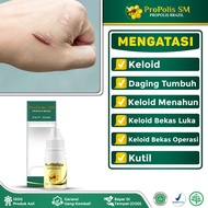 Obat Keloid Daging Tumbuh Keloid Menahun Keloid Bekas Luka Operasi Keloid Di Dada - Propolis SM