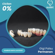 Gigi Palsu Permanen Crown