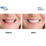 [PRODUCT CODE IJTSW9265] Snap On Smile Authentic Snapon Smile Denture/ 1 Set of Dental Veneers 1 SET