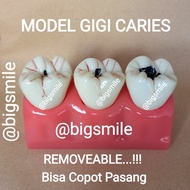 Model Gigi Implant Bridge Crown Model Gigi Caries Karies Removeable